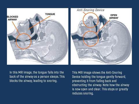 Anti-Snore Tongue Stabilizing Device Non-Invasive Nighttime Support - Image 4